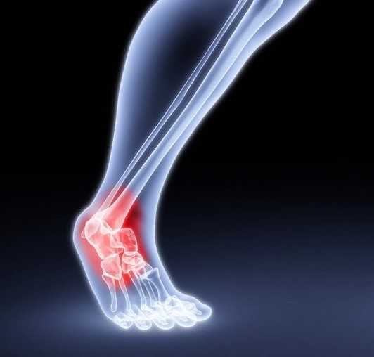 EVFAS | Post-Traumatic Arthritis