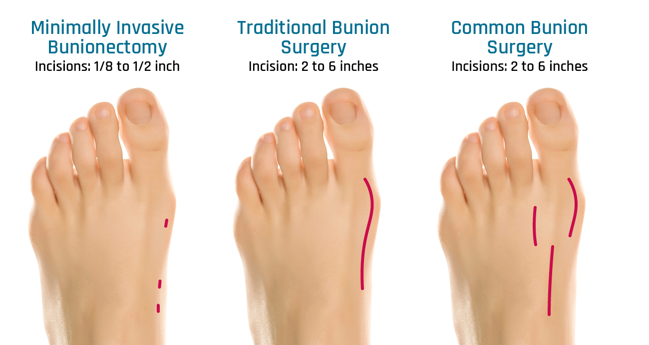 picture showing the different incisions of bunion surgeries.